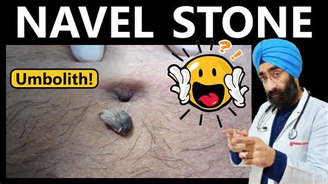 navel stone symptoms|Navel Stone: What It Is, Causes, and Removal